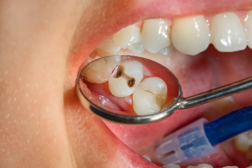 caries treatment at home